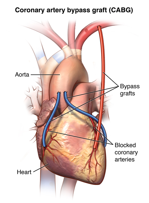 Front view of heart with artery and vein bypass grafts.