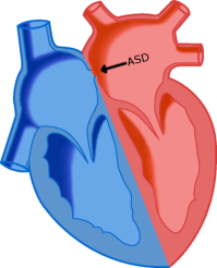 ASDheart
