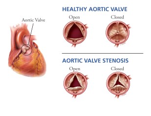 aortic-valve-stenosis
